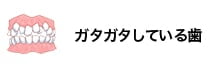 ガタガタしている歯